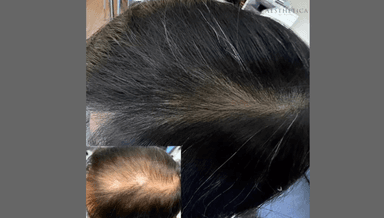 Image for Scalp Needling - Hair Growth Stimulation