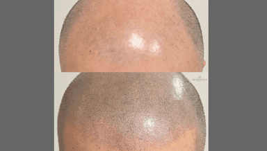 Image for Scalp Micropigmentation (SMP)